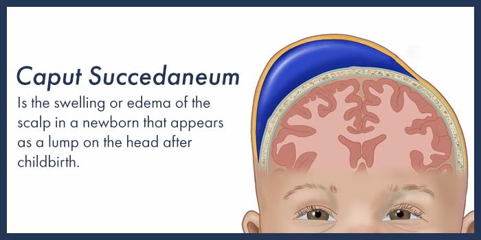What is Caput Succedaneum?