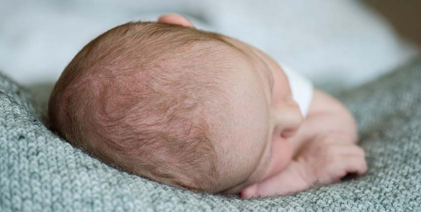 caput succedaneum