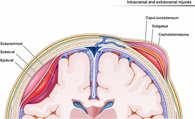 Signs and Symptoms of Caput Succedaneum