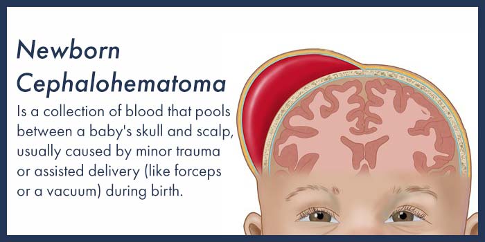 Newborn Cephalohematoma