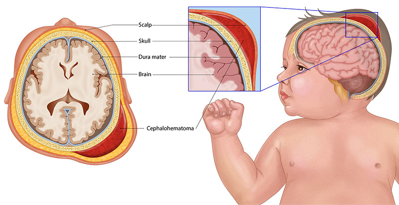 Diagnosing Cephalohematoma