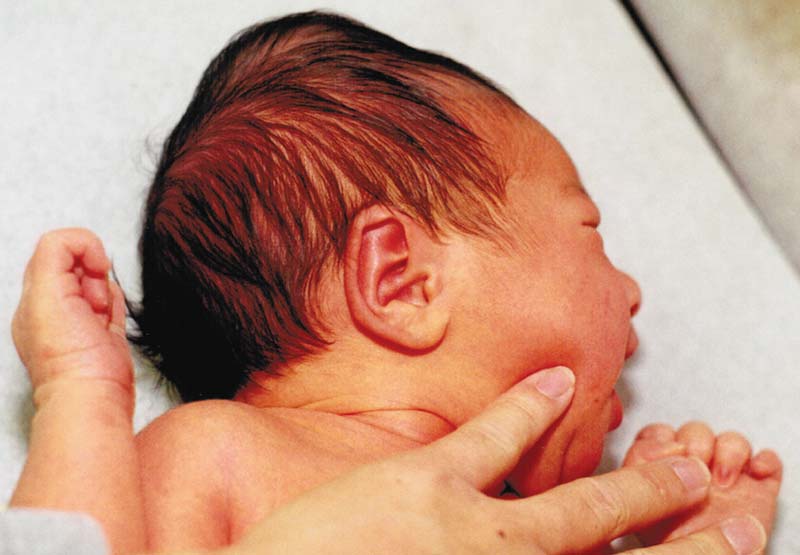 Newborn Cephalohematoma