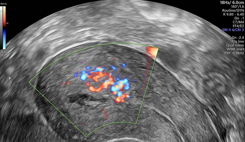 What is Retained Products of Conception (RPOC)