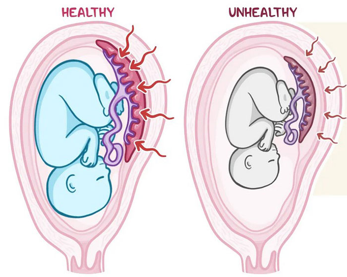 IUGR Birth Complications