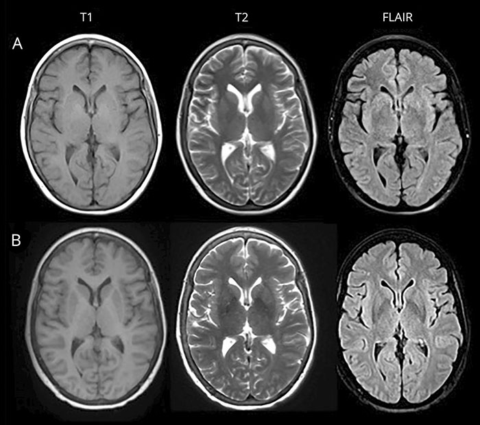 MRI of the Brain