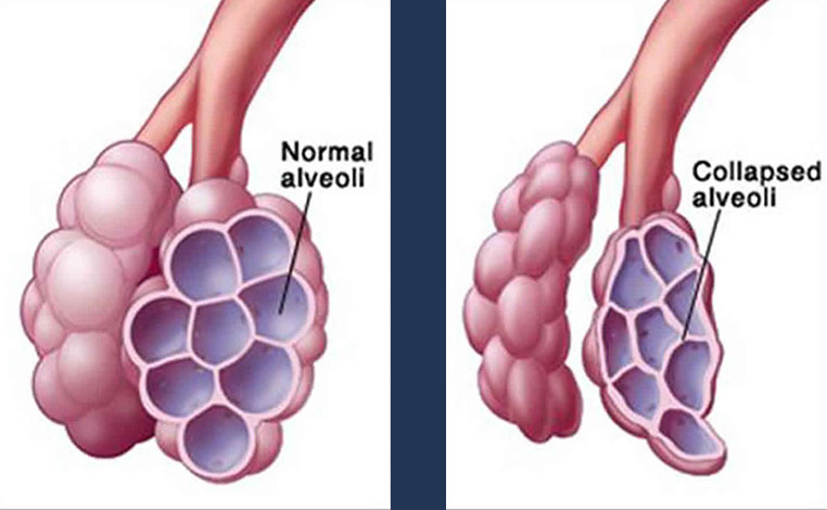 Collapsed Alveoli