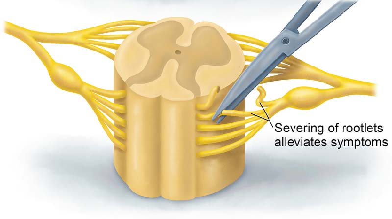 SDR Nerve Cut