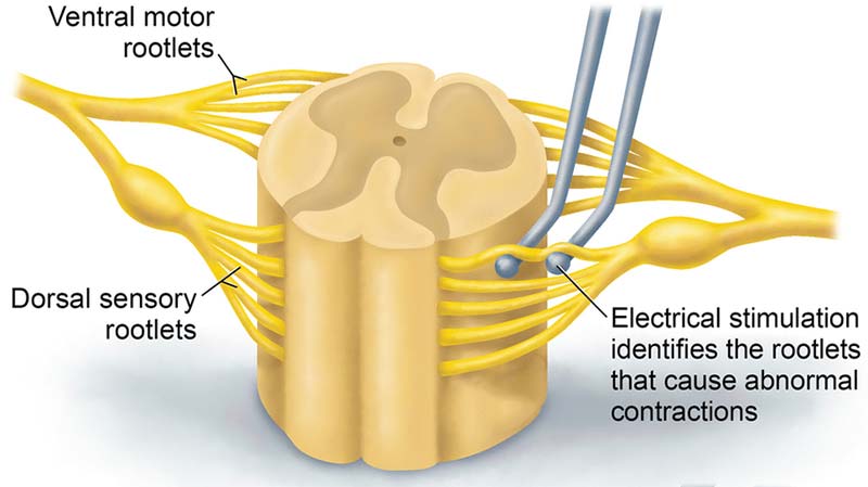 SDR Nerve Stimulation