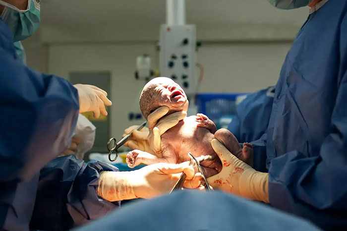 C-section delivery