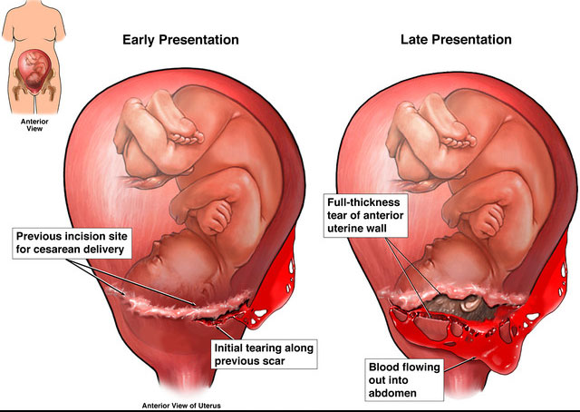 Uterine Rupture