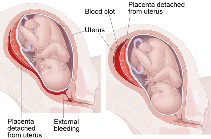 placental separation