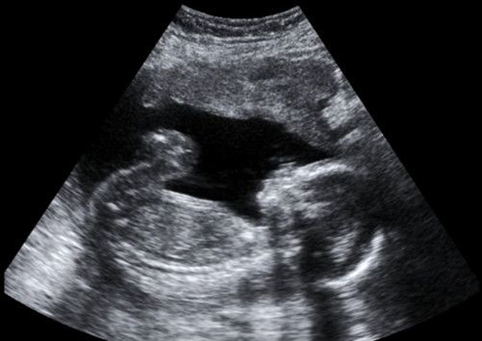  prenatal ultrasound