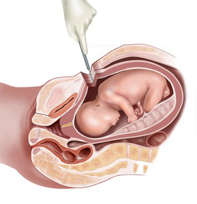 c-section