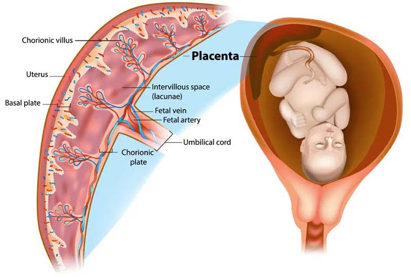 Placental Complications