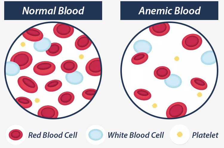 Anemia In Infants