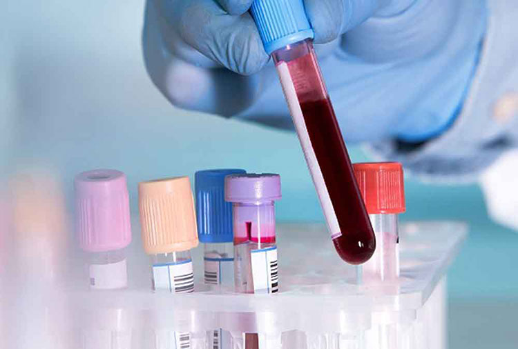 Blood Test After Birth for Anemia