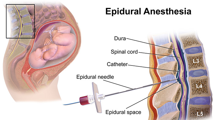 Epidural Anesthesia and Cerebral Palsy
