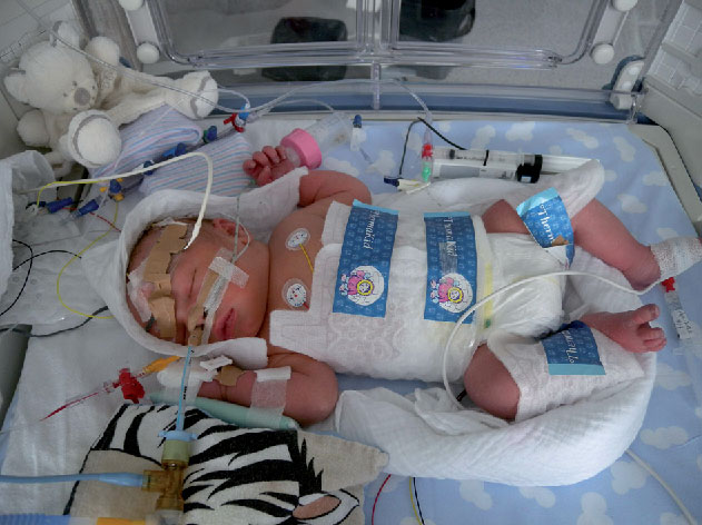 Neonatal Hypothermia Treatment