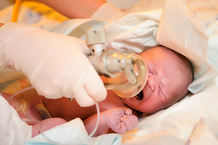 Neonatal Resuscitation