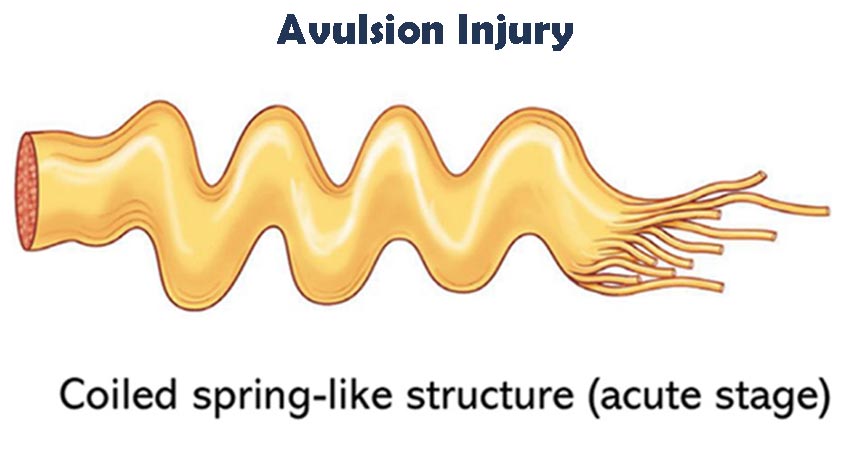 brachial plexus avulsion