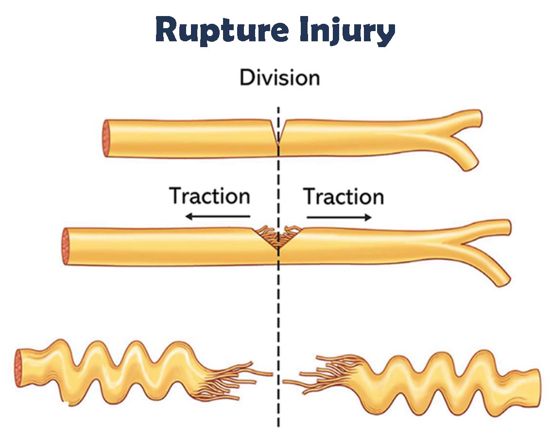 brachial plexus rupture