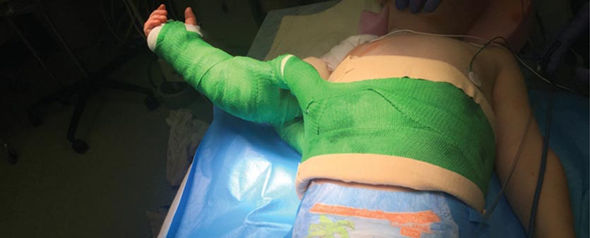 joint reduction surgery for brachial plexus