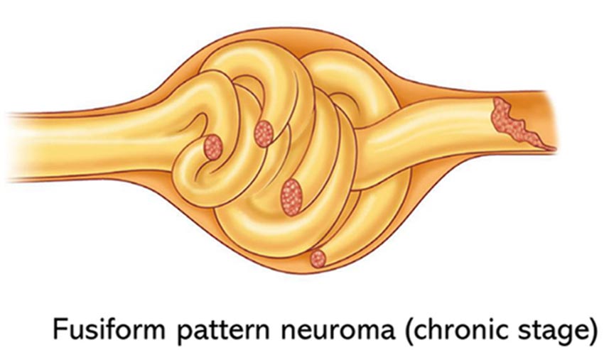 brachial plexus neuroma