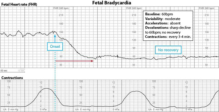 FHR Bradycardia