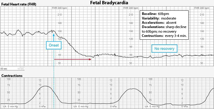 Bradycardia Fetal Heart Rate Strip