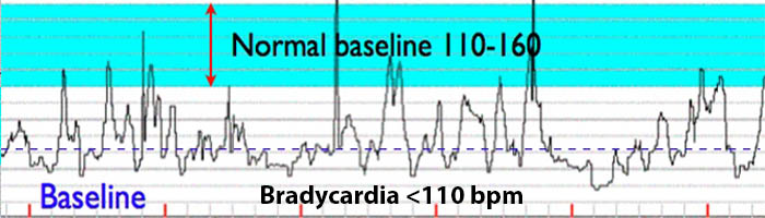Bradycardia Fetal Heart Rate Strip