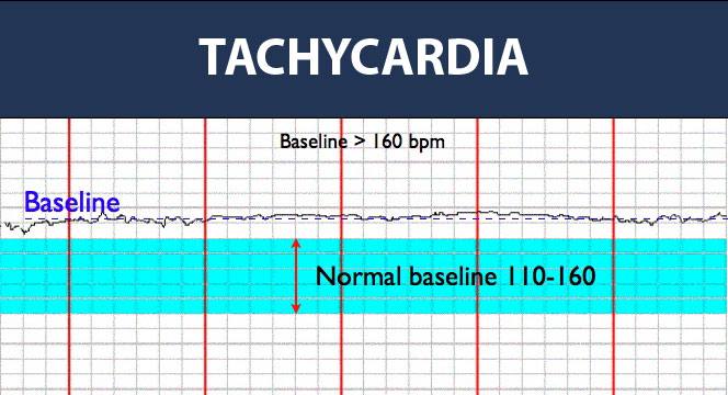 Fetal Tachycardia