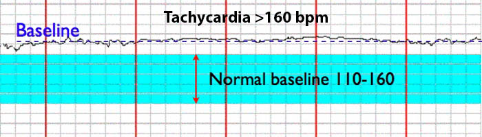 Tachycardia Fetal Heart Rate Strip