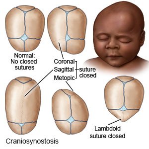 craniosynostosis