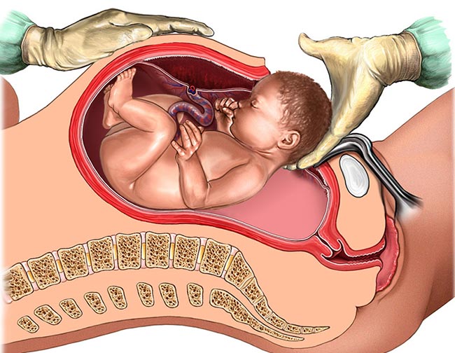 cesarean diagram