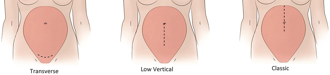 C-section types