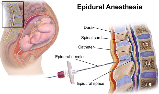 epidural diagram