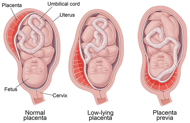 Placenta Birth Complications