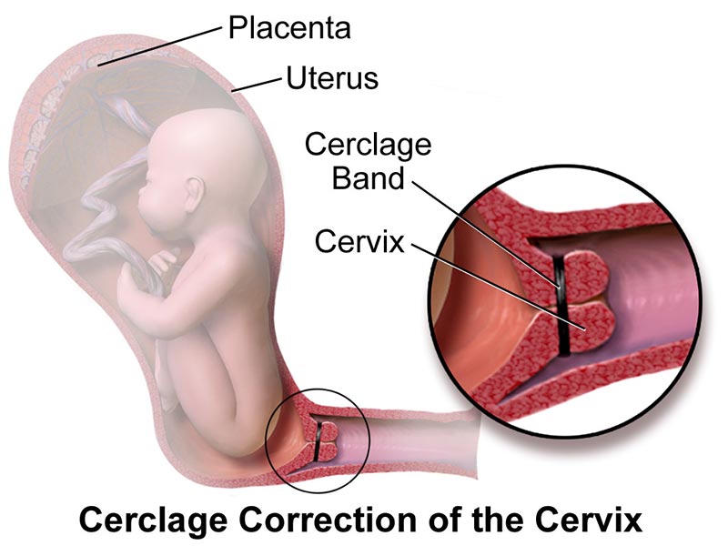 Cervical Cerclage Treatment for Incompetent Cervix