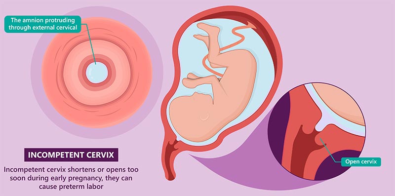 What is an Incompetent Cervix?