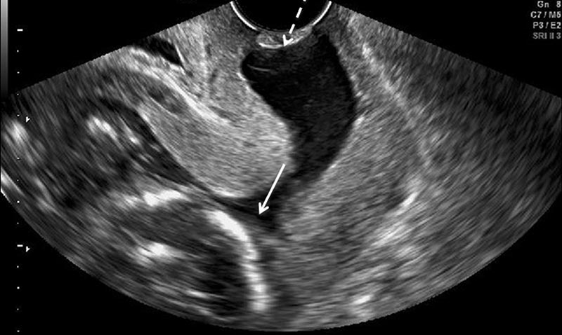 transvaginal ultrasound of incompetent cervix