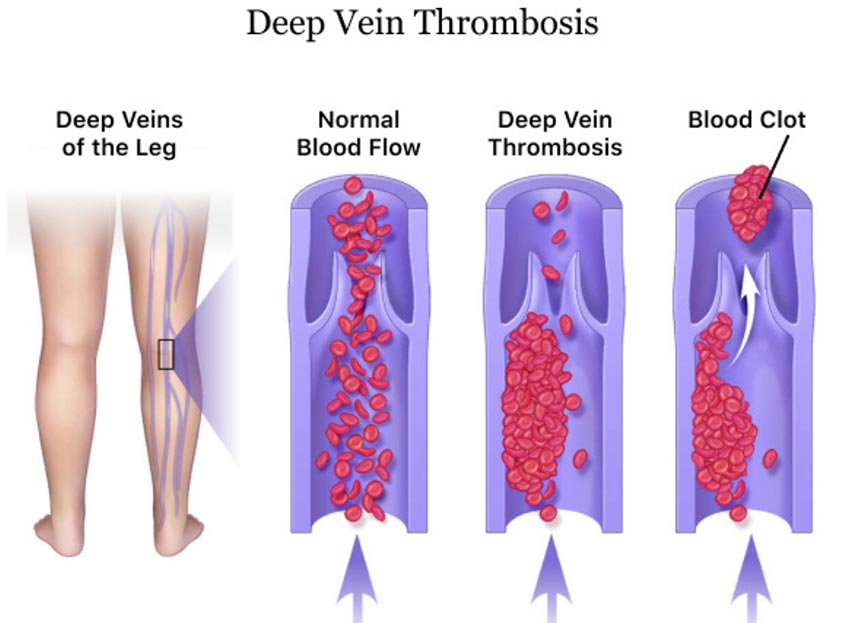 deep vein thrombosis