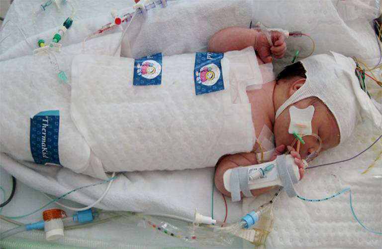 neonatal brain cooling