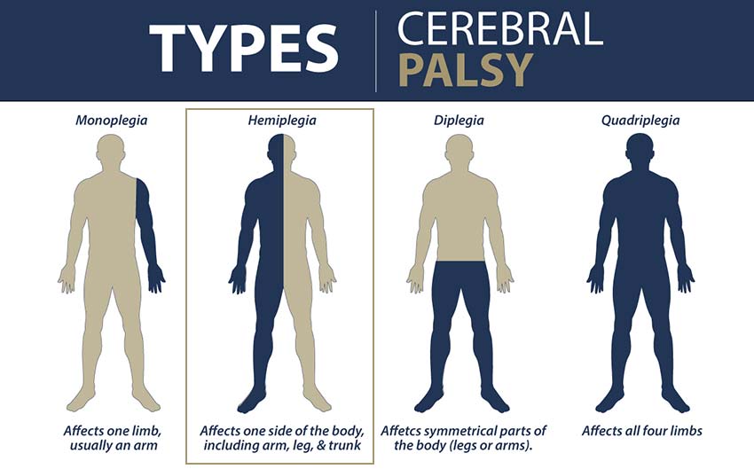what is hemiplegia