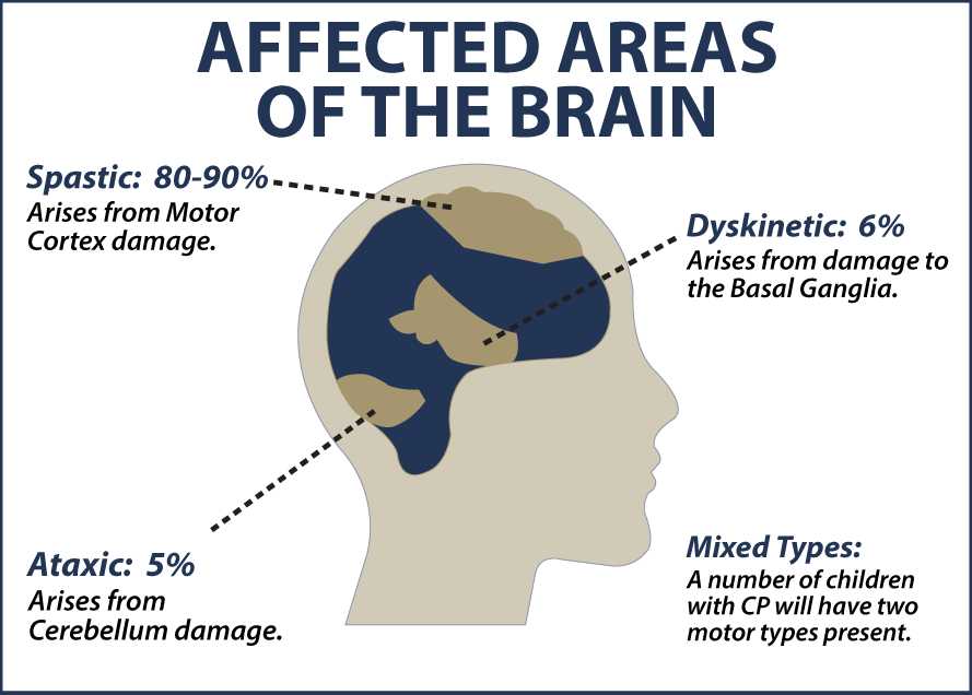 CP Affected Areas of the Brain