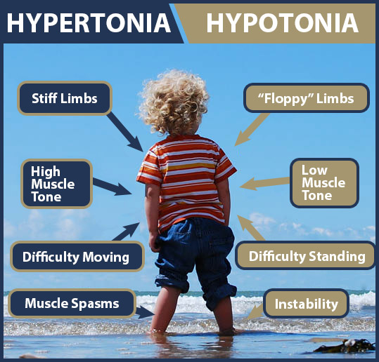 Cerebral Palsy Hypotonia