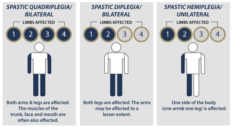 Spastic Palsy Areas of Spacticity