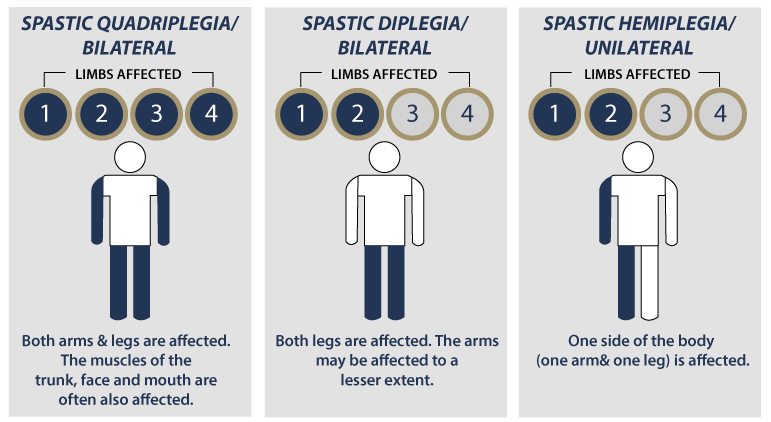 spastic quadriplegia