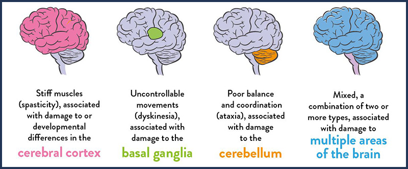 Types of Cerebral Palsy
