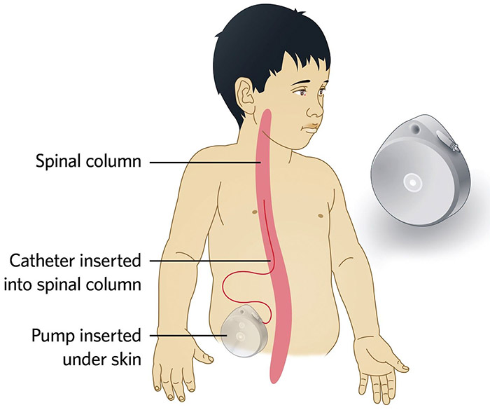 intrathecal baclofen pump