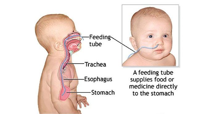 Dysphagia